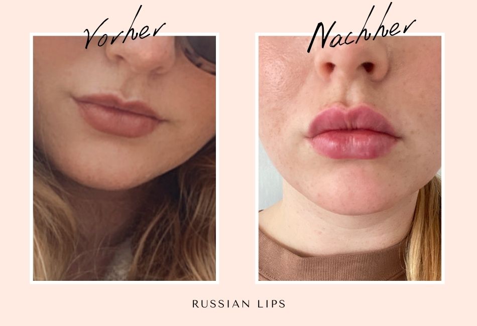 Avant / Après Lèvres Russes